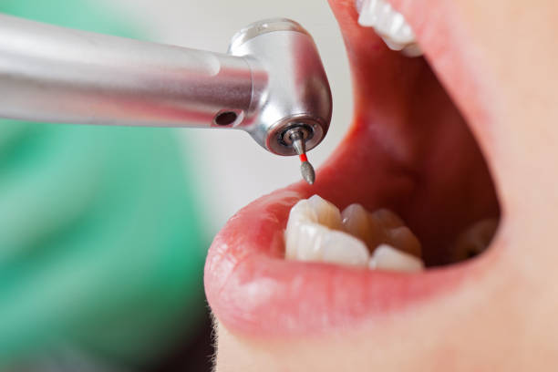 Best Emergency Dental Care for Broken or Chipped Teeth in Woodstock, VA